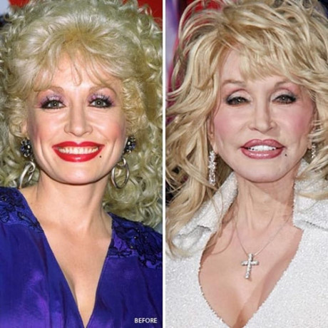 Dolly Parton nổi tiếng là một ngôi sao lớn của dòng nhạc Đồng Quê, tuy nhiên người ta còn biết đến bà là người nghiện phẫu thuật thẩm mỹ. Nữ ca sỹ chia sẻ mình đã trải qua nhiều lần nâng mặt, phẫu thuật ngực (cả tăng và giảm kích cỡ), cắt mí, nâng cơ lông mày, hút mỡ, độn cằm, bơm môi,…