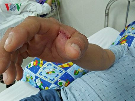 Một bệnh nhân bị rắn cắn vào tay