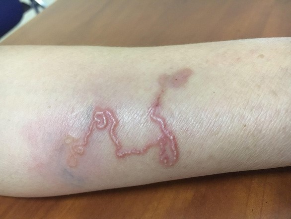 Ấu trùng giun đũa chó mèo di chuyển trên da cánh tay bệnh nhân - Ảnh: BVCC