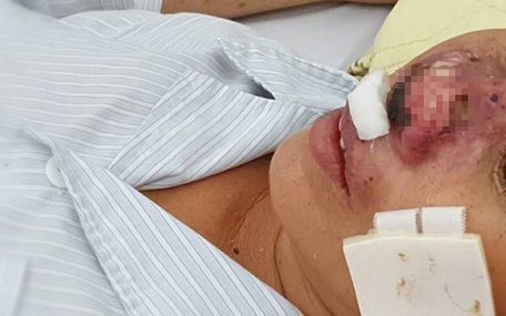 Một bệnh nhân nữ mắc whitmore khá hy hữu, với trình trạng vi khuẩn whitmore “ăn” cánh mũi điều trị tại Trung tâm Bệnh Nhiệt đới, Bệnh viện Bạch Mai.