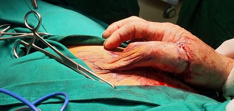 Bác sĩ phẫu thuật dùng da vùng bẹn tạo hình lại ngón tay bệnh nhân bị tai nạn thương tích (ảnh bệnh viện cung cấp).