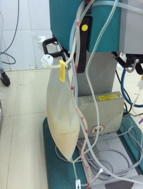 Huyết thanh 1 bệnh nhân đục như sữa sau khi lọc lấy ra đã kịp thời cứu sống bệnh nhân viêm tụy cấp.