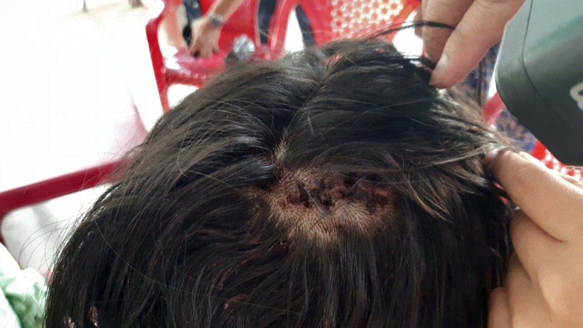 Vết thương trên đầu của nữ sinh sau khi bị tấn công.