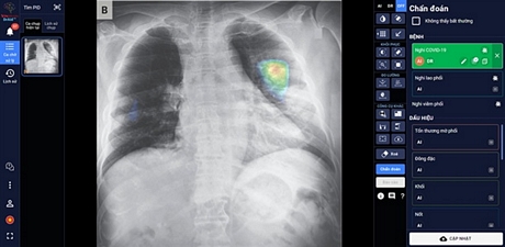 Ứng dụng “DrAid for Radiology” có khả năng phát hiện, sàng lọc trên 21 dấu hiệu bất thường và bệnh lý về phổi- tim- xương.