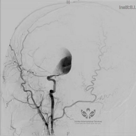 Hình ảnh túi phình mạch máu não khổng lồ của bệnh nhân 29 tuổi.Ảnh bệnh viện cung cấp