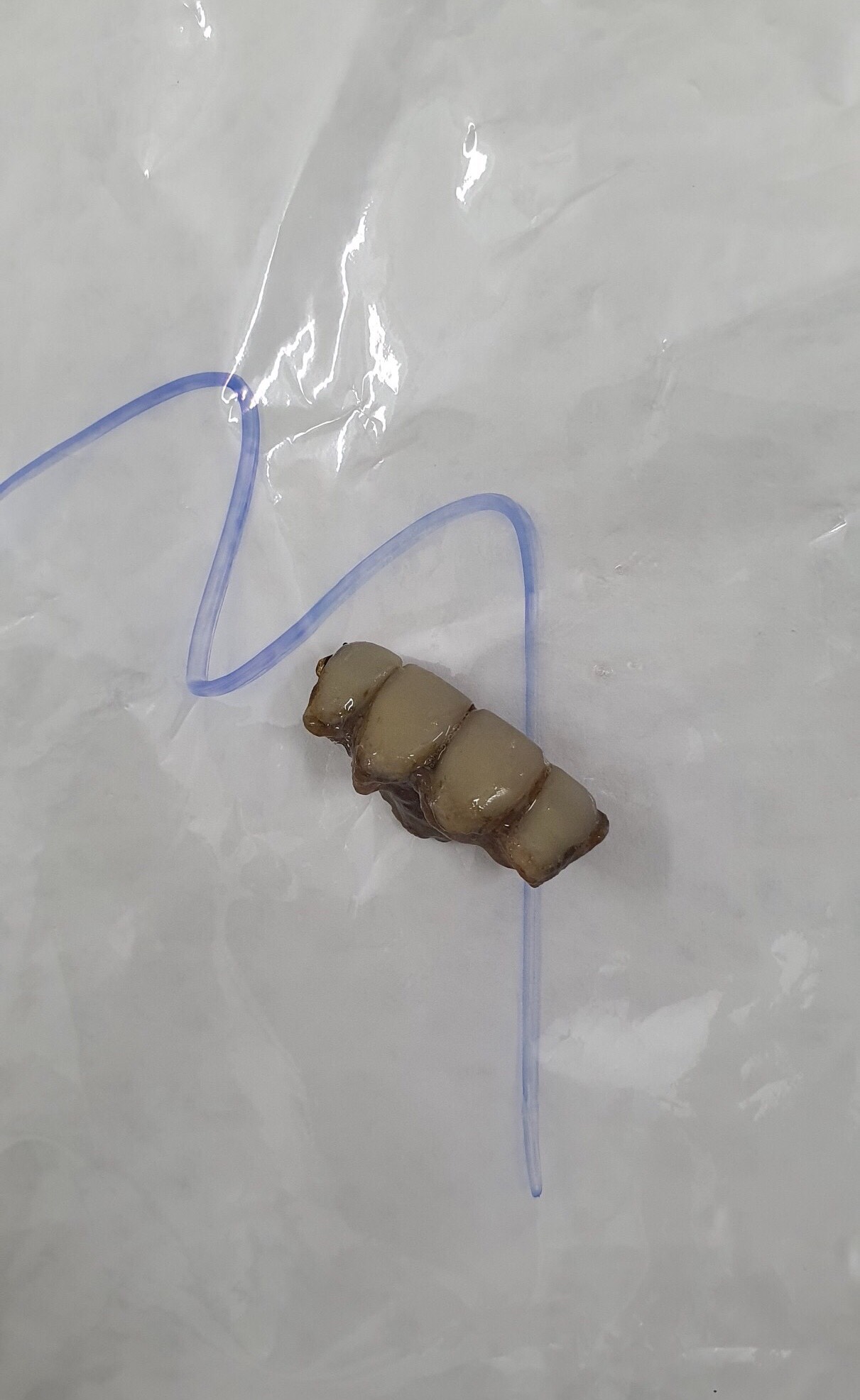 -4 chiếc răng sau khi được lấy ra khỏi phế quản của BN.