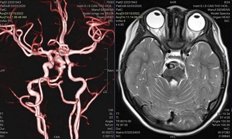 Hình ảnh MRI khối dị dạng mạch máu não của bé A.N. tại BVĐK Quốc tế S.I.S Cần Thơ.  Ảnh: Bệnh viện cung cấp