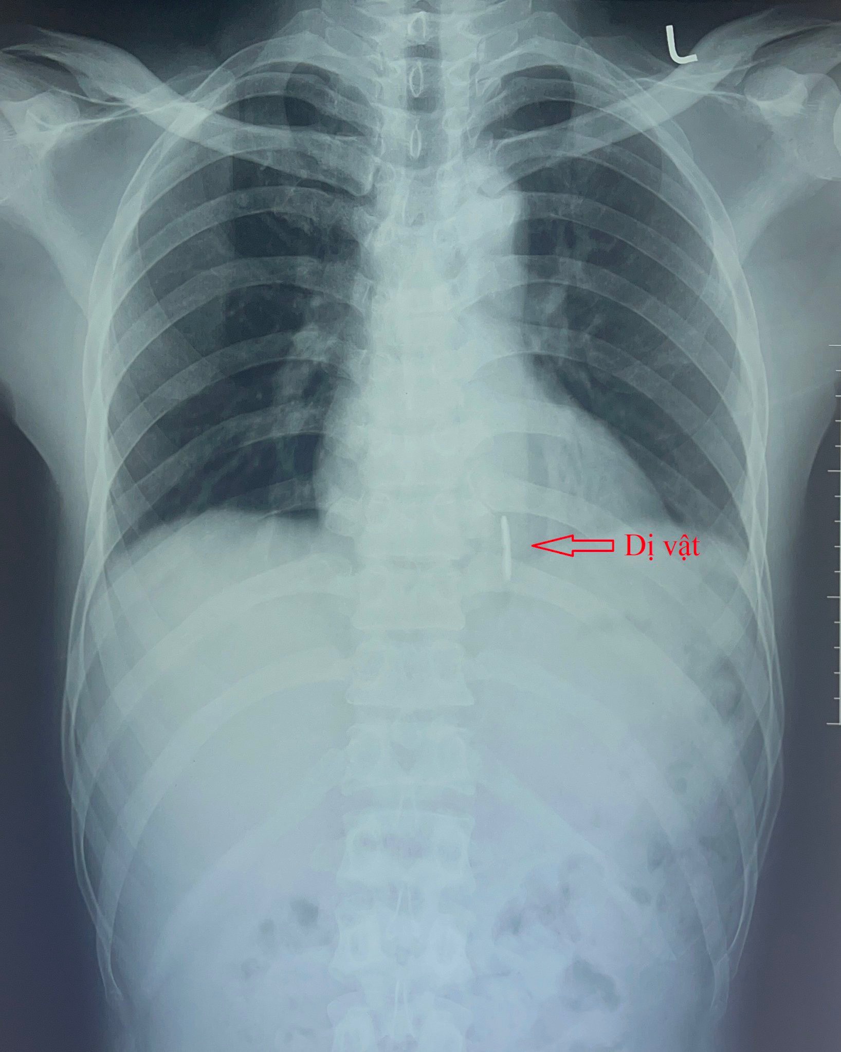 Hình ảnh dị vật trên phim X quang phổi.