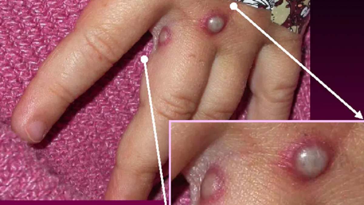 Hình ảnh triệu chứng của bệnh đậu mùa khỉ xuất hiện trên tay của một bệnh nhân vào 27/5/2003. (Ảnh CDC/Getty)
