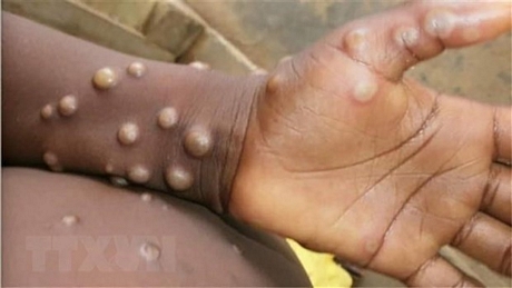 Các phần bị tổn thương xuất hiện trên tay và chân em nhỏ bị nghi mắc bệnh đậu mùa khỉ. Ảnh: Getty Images/TTXVN