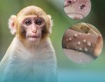Chủ động phương án ứng phó bệnh đậu mùa khỉ