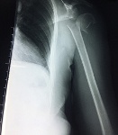 Phẫu thuật kết hợp xương cánh tay cho bệnh nhân lớn tuổi