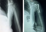 Phẫu thuật kết hợp xương cánh tay cho bệnh nhân lớn tuổi