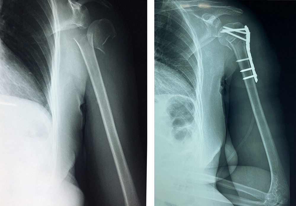 Bệnh nhân gãy phức tạp vùng đầu trên xương cánh tay trái và ca phẫu thuật thành công được bác sĩ cố định các mảnh xương gãy.