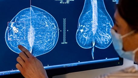 Bác sĩ kiểm tra hình ảnh chụp X-quang tuyến vú để sàng lọc ung thư vú.